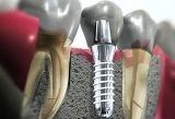 danties implantas